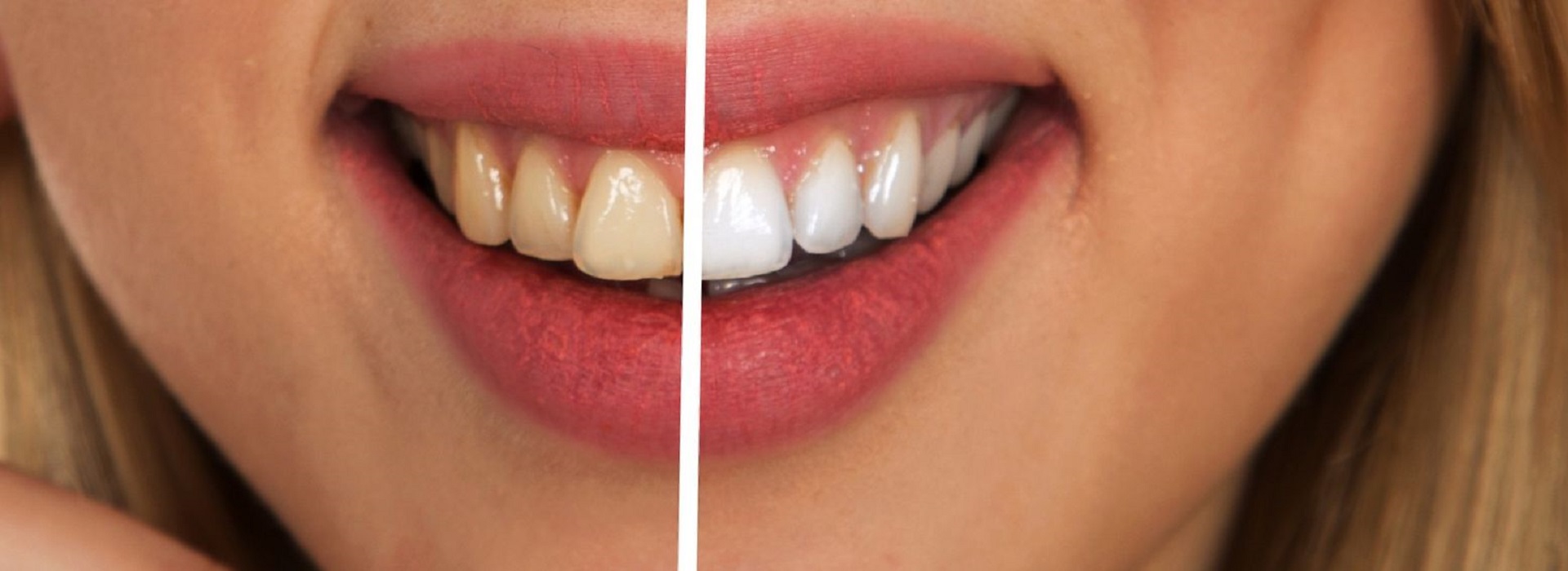Foto Massimo Pomo Sbiancamento Denti